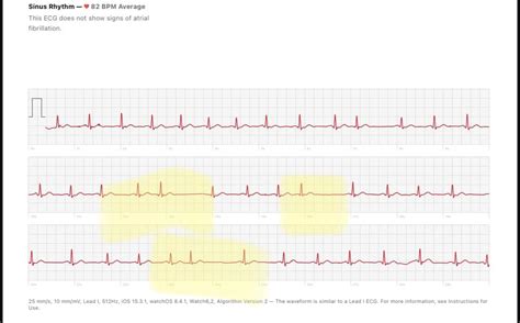 two heart beats close together.